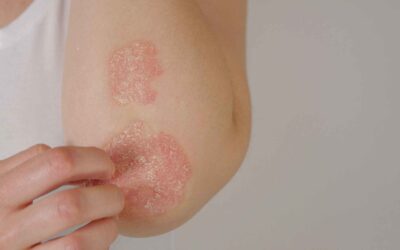 What is Psoriasis? – Causes and Management Strategies